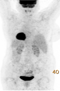 Gallery Detail: The Complete Remission Of A Diffuse Large B Cell Lymphoma